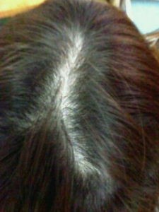 つむじハゲ 枝分かれなど の原因と対策 薄毛を隠すスタイルとは Iqumore イクモア 女性の薄毛や抜け毛対策 いつまでもきれいな髪をiqumore イクモア 女性の薄毛や抜け毛対策 いつまでもきれいな髪を