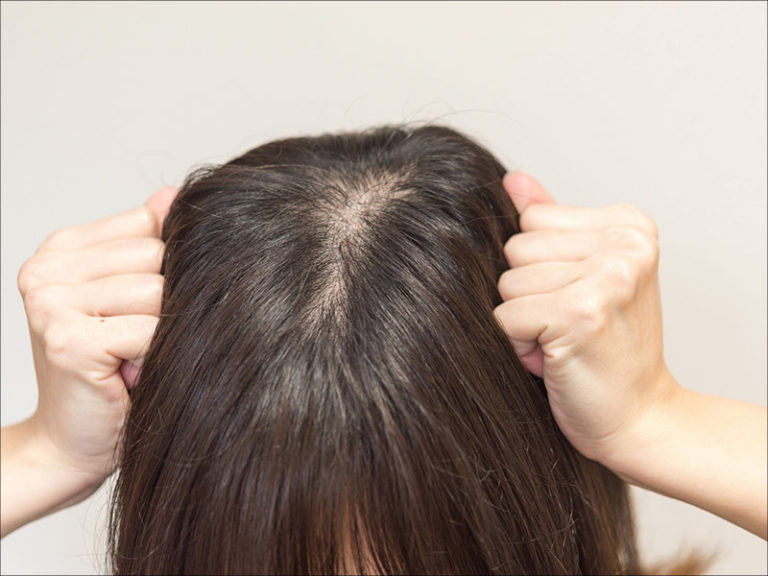 つむじハゲが気になる20代女性の悩み……薄毛の原因と対策は？